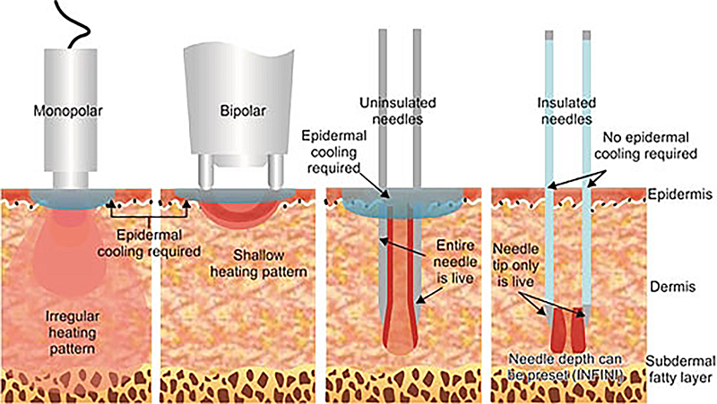 insulated vs non-insulated RF needles
