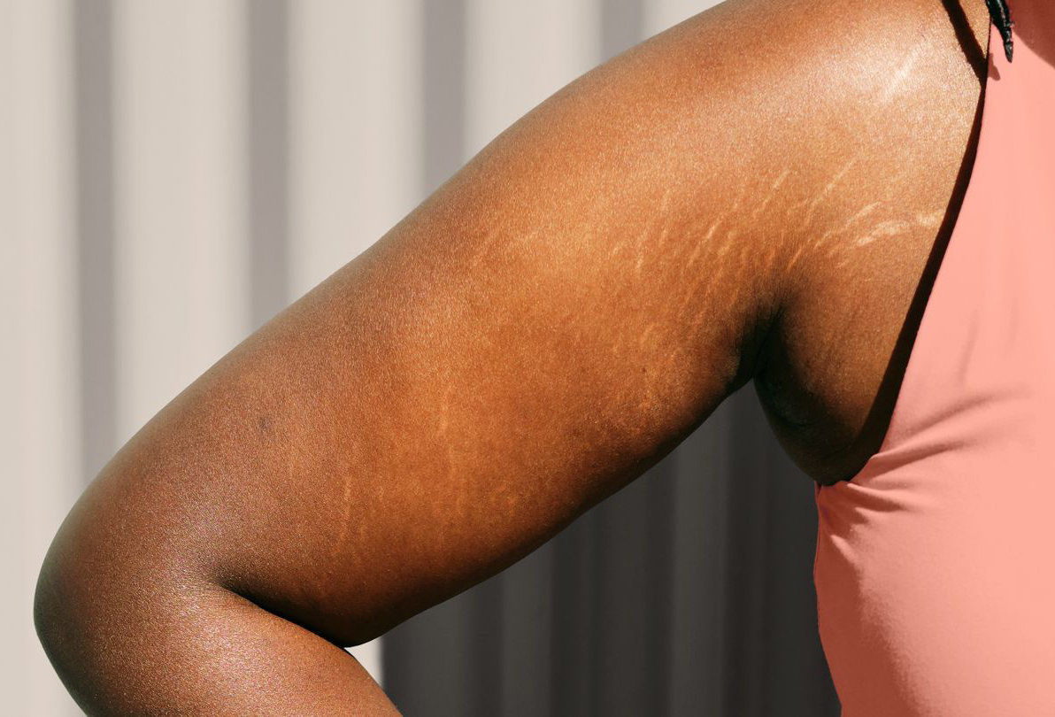 tattoing stretch marks on darler skin types
