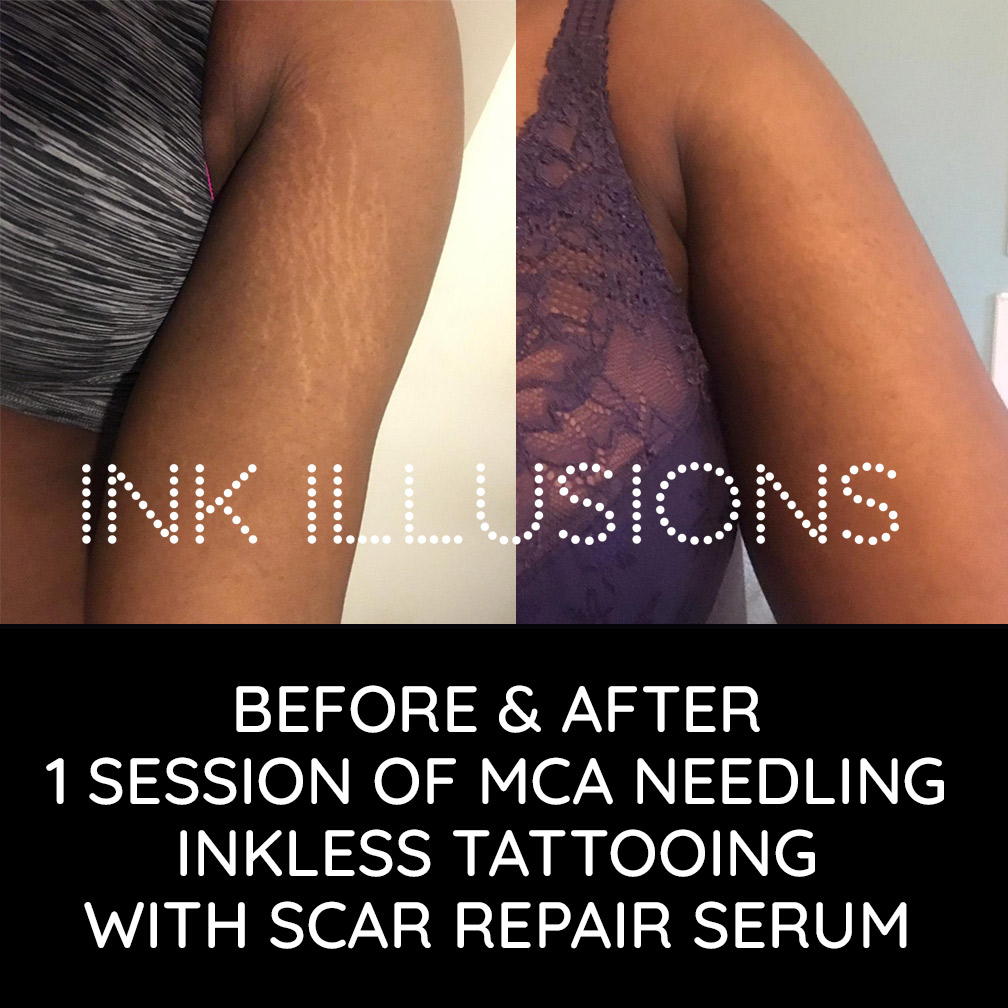 arm stretch marks best removal treatment