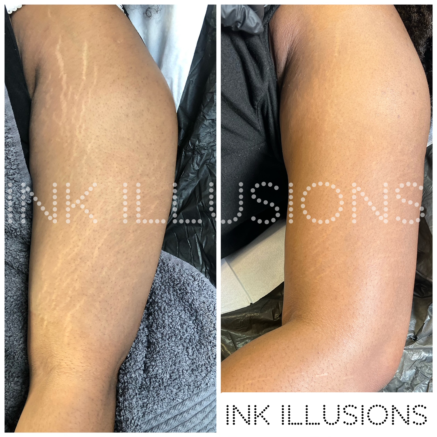 before and after photos stretch mark tattooing