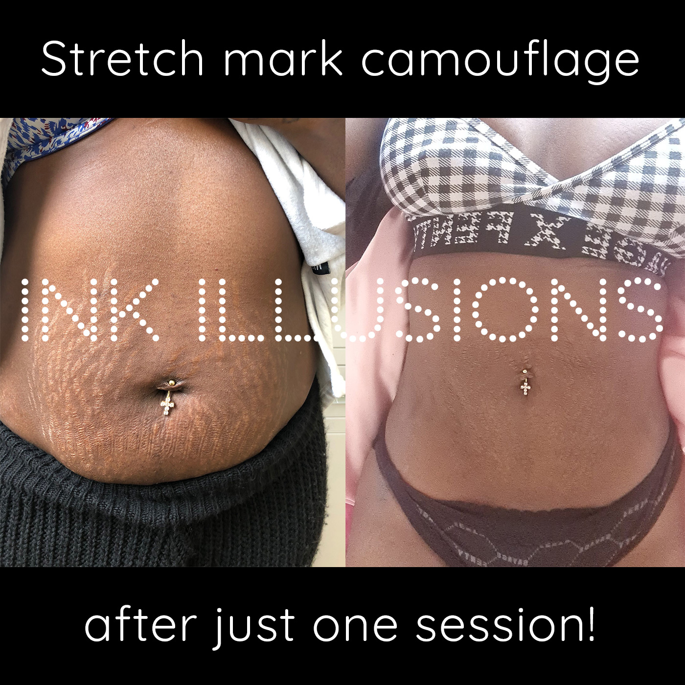 stomach tummy stretch marks treatment
