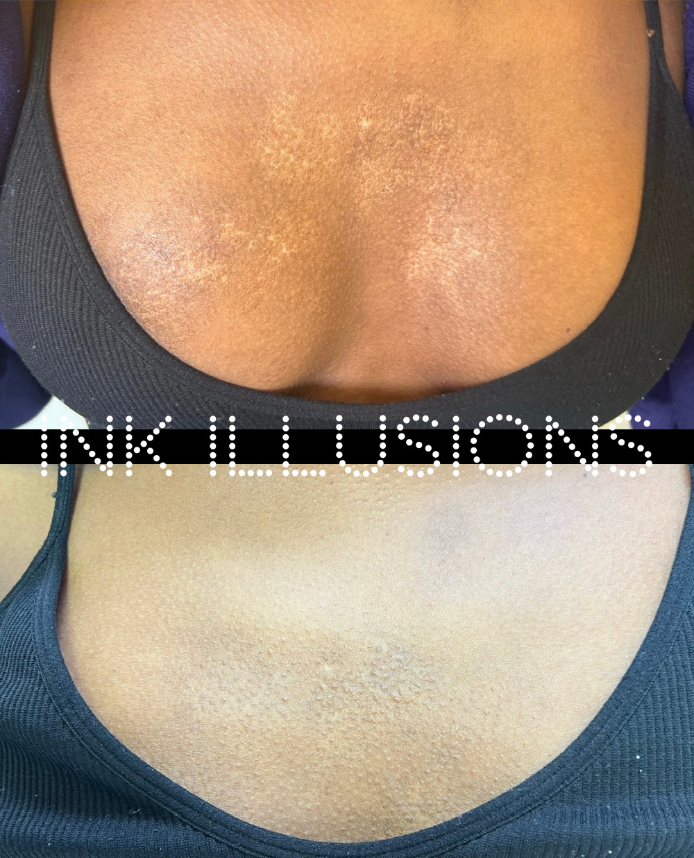 burn scar dark skin tattoo camouflage