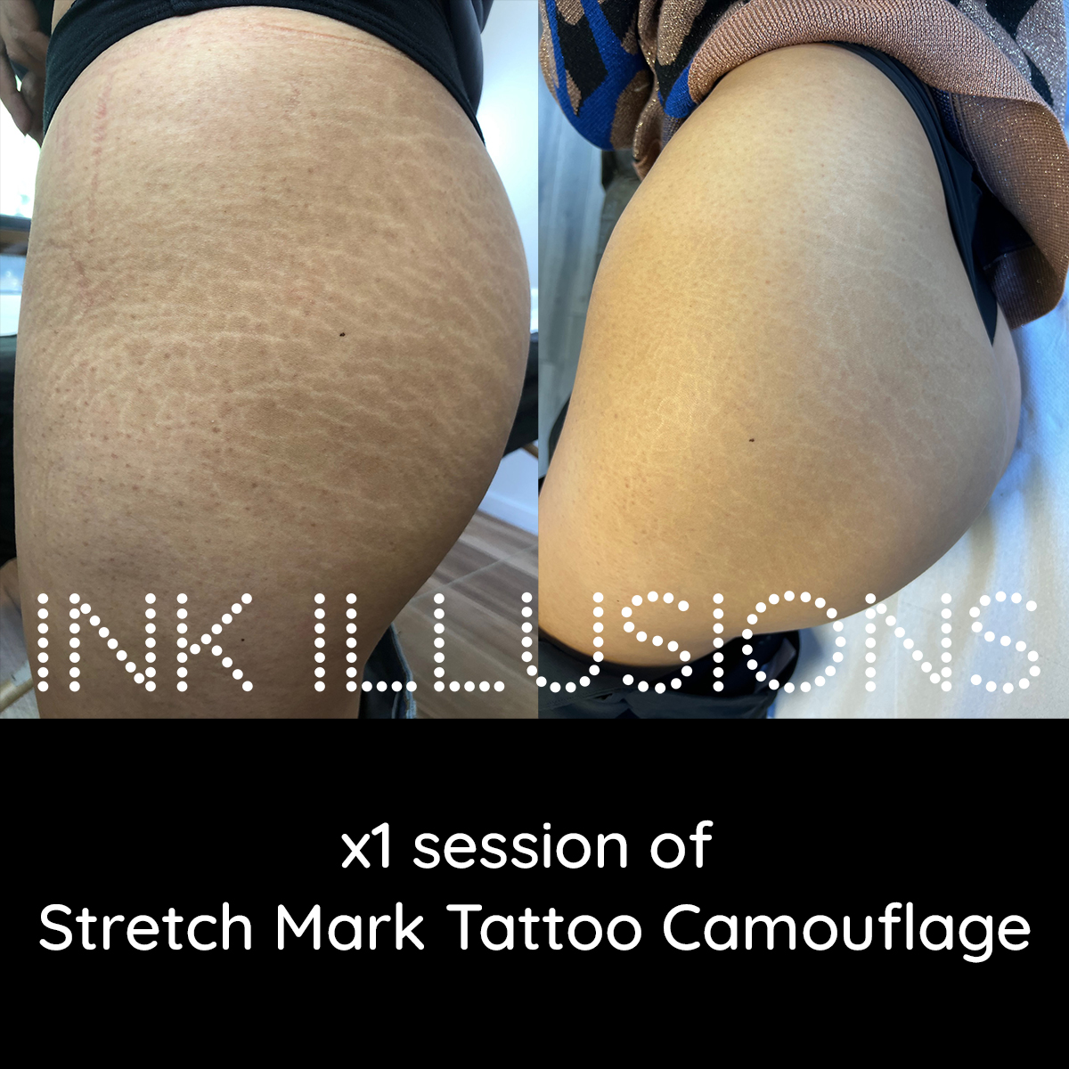 buttocks bottom sttretch mark removal