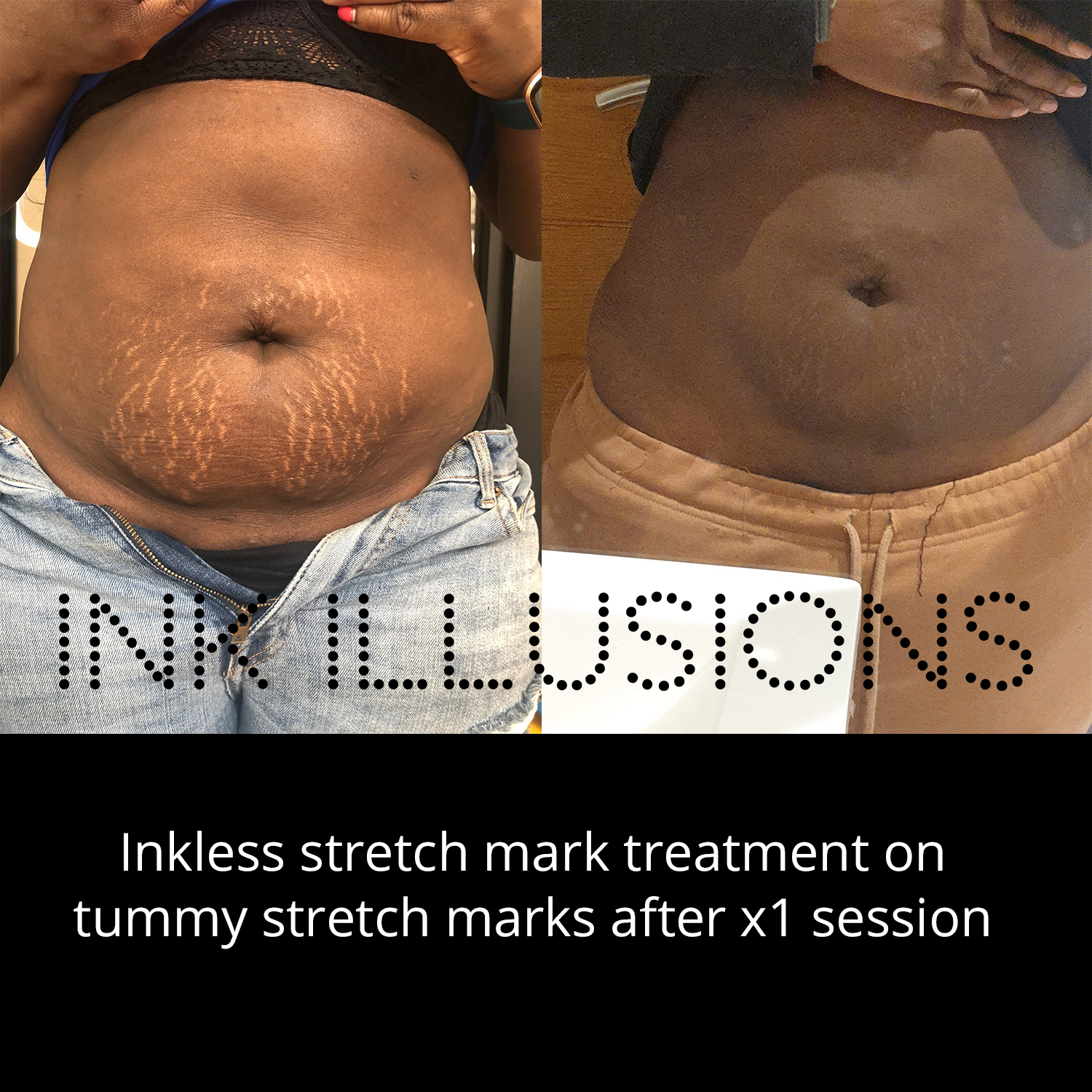 pregnancy stretch marks removal