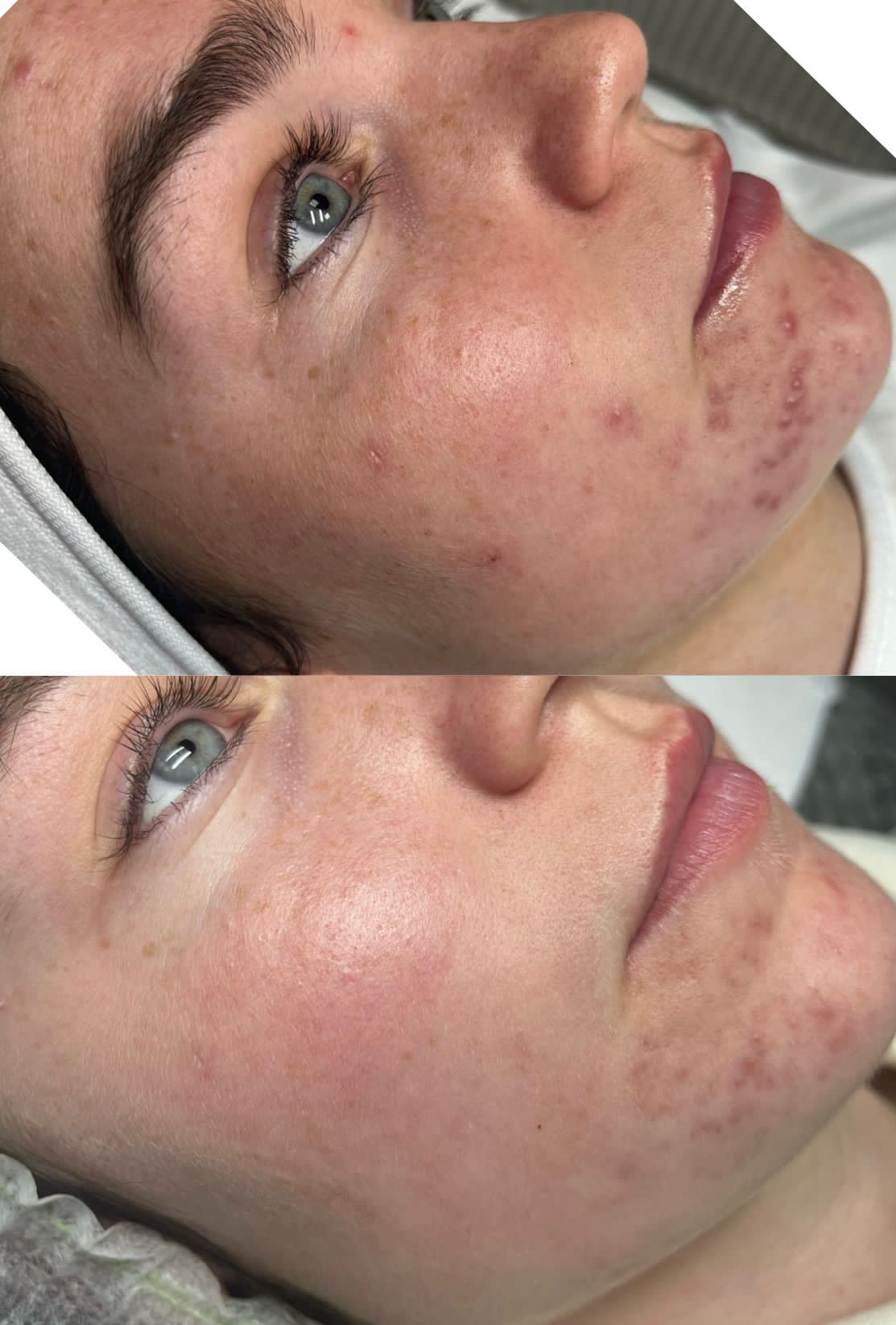 SQT facial before after