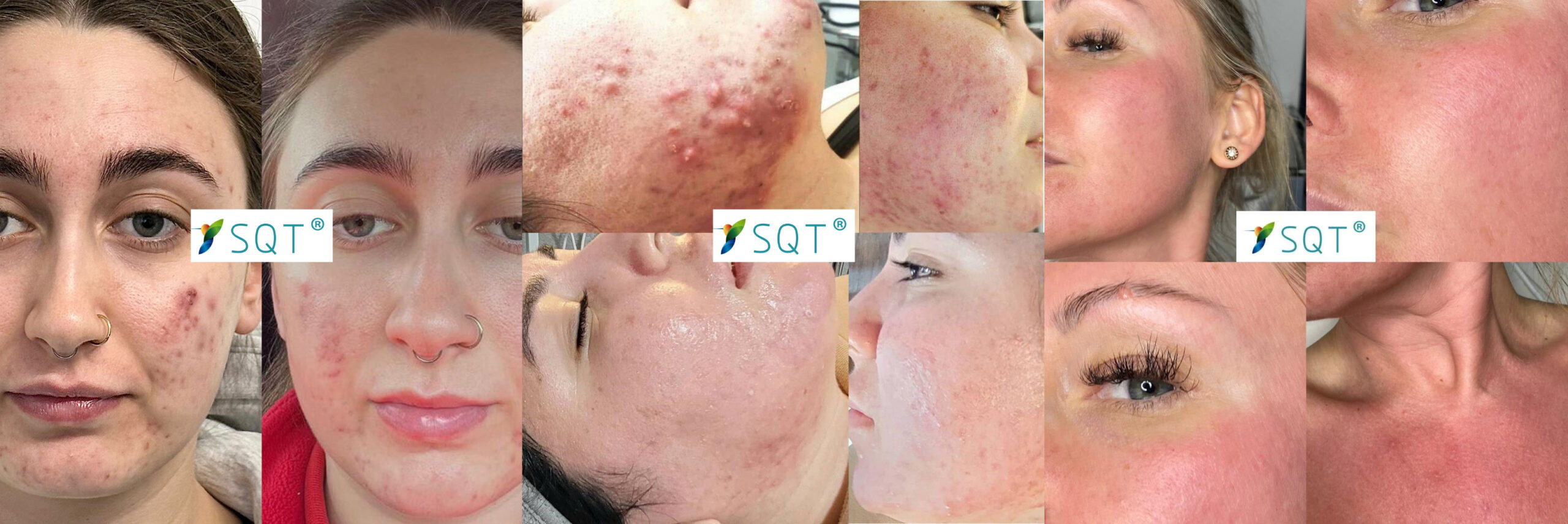 SQT biomicroneedling before after london