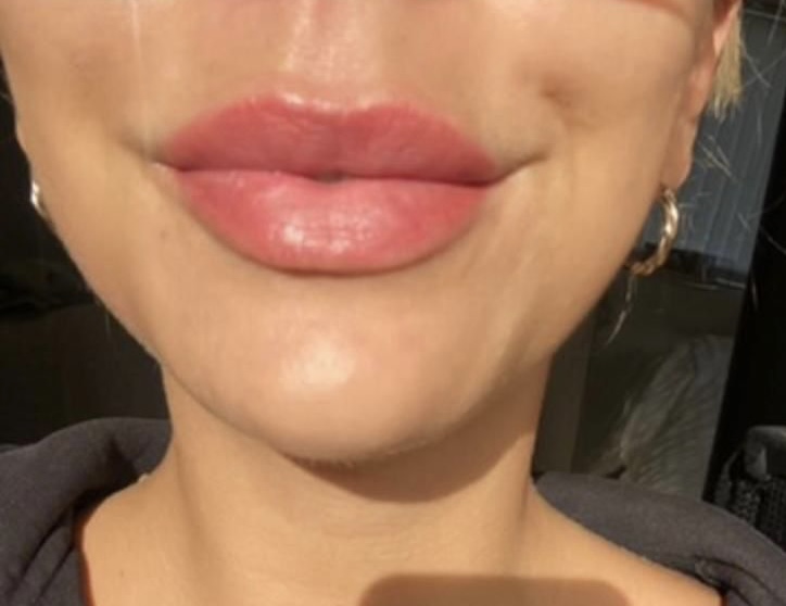 healed pmu lips london