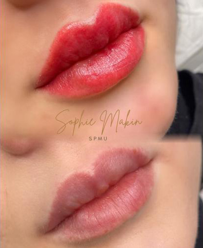 PMU lips before after London