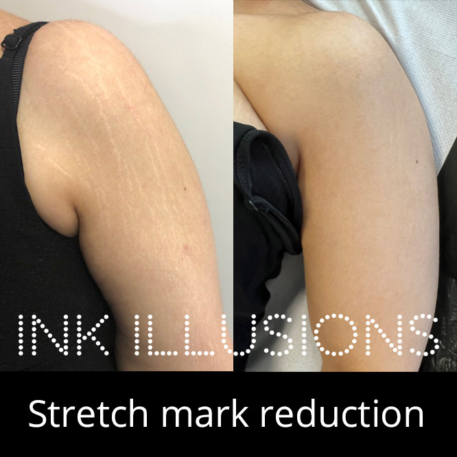 before after stretch mark camouflage